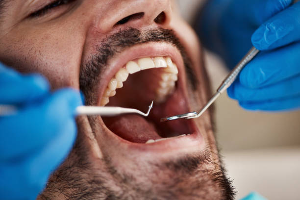Best Emergency Dentist for Lost Fillings or Crowns in Springhill, LA